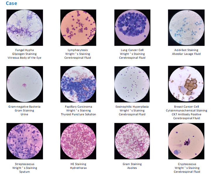 Application of the Welso Cytocentrifuge in the Body Fluid Cytology Sector Application of the Welso Cytocentrifuge in the Body Fluid Cytology Sector